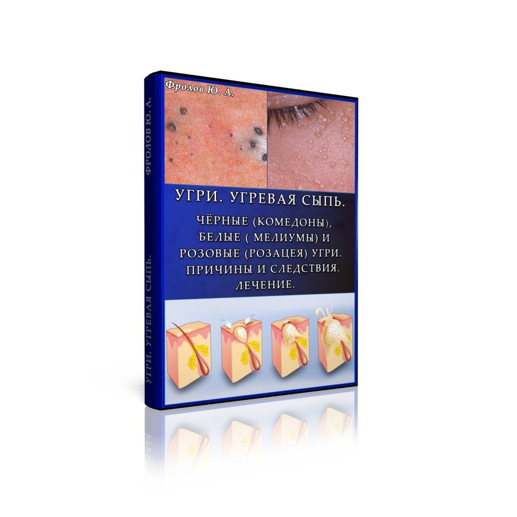 Мини инфопродукт №11. Угри. Угревая сыпь. Причины _0.png